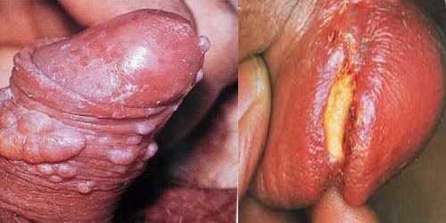 bagaimana cara mengobati sipilis