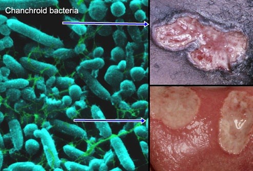 Obat Sipilis Di Warung